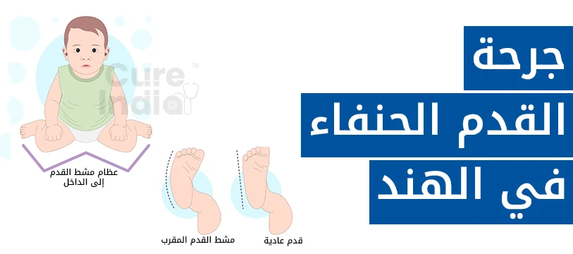 نسبة نجاح علاج القدم الحنفاء